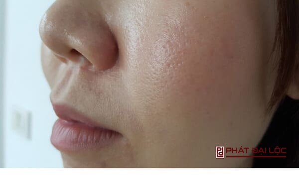 da mặt dầu thường khiến các lỗ chân lông, bóng trên khuôn mặt