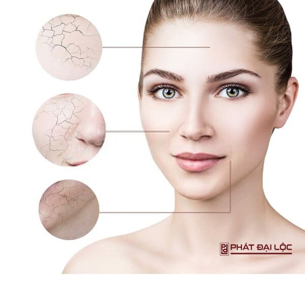 da hỗn hợp tập trung chử yếu vùng trán, mũi và cằm