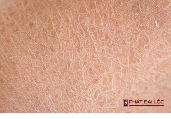 da mặt khô thường sẽ thấy các lỗ chân lông nhỏ xíu hoặc không có