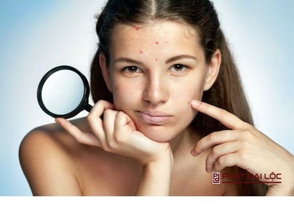 Không tự ý nặn mụn càng làm da trở nên bị viêm nhiễm