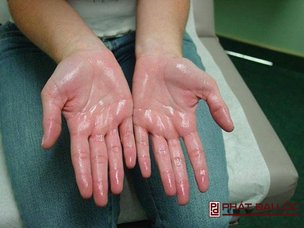 Đổ mồ hôi tay là dấu hiệu của phong thấp
